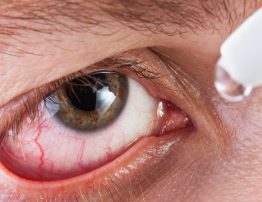 Síndrome do Olho Seco: você sabe o que é?