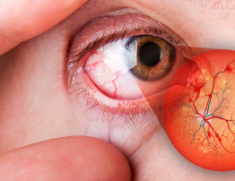 Retinopatia Diab&eacute;tica: como saber se eu tenho? Como tratar?